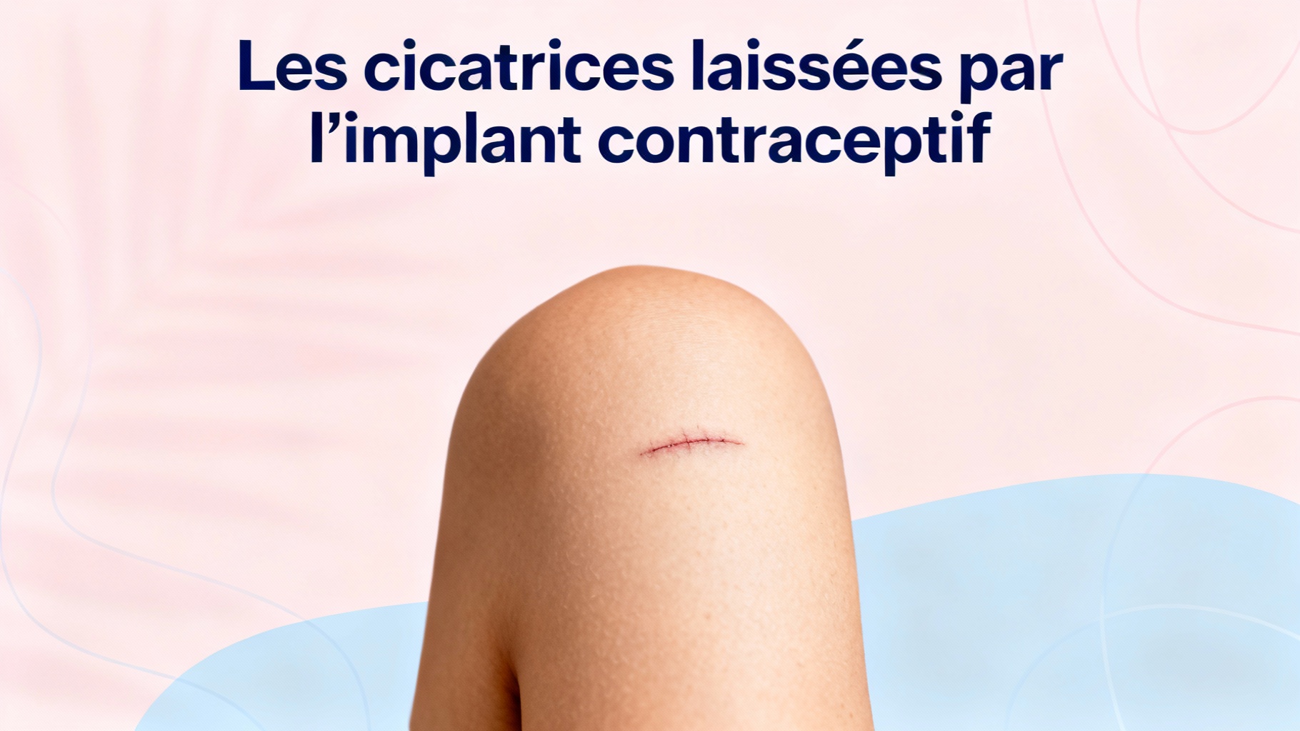 Les cicatrices laissées par l'implant contraceptif